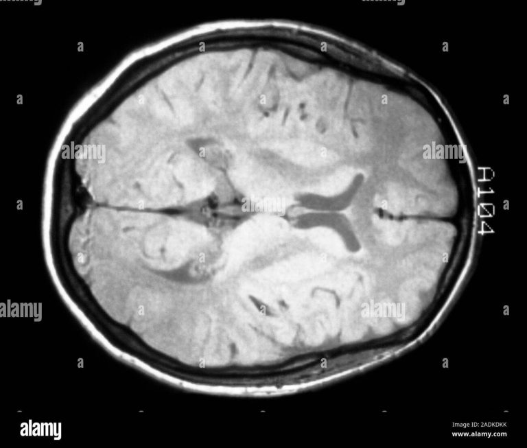 Picture one A healthy human brain